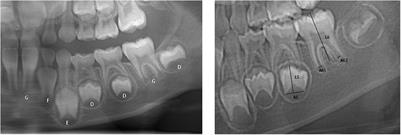 Evaluation of a machine learning algorithms for predicting the dental age of adolescent based on different preprocessing methods